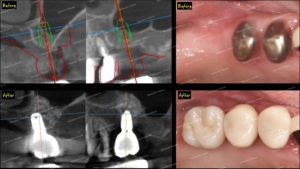 サイナスリフト　歯科インプラントの骨再生・造成　１